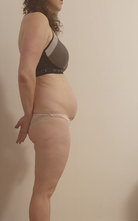 Zuzana P. — pred rehabilitácii